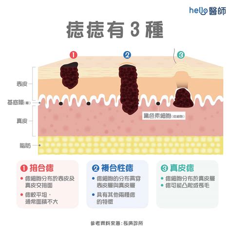 痣突出來|為什麼臉上的痣越來越多？皮膚科醫師解析長痣原因、。